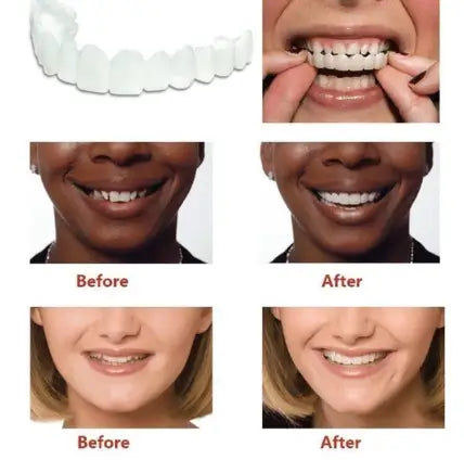 Instant Smile Comfort Upper & Lower Veneer Set