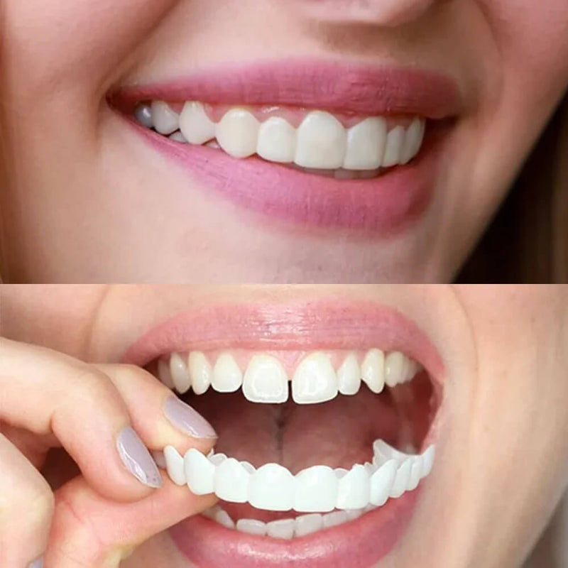 Instant Smile Comfort Upper & Lower Veneer Set