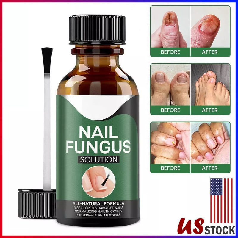 Fingernail Fungus Treatment
