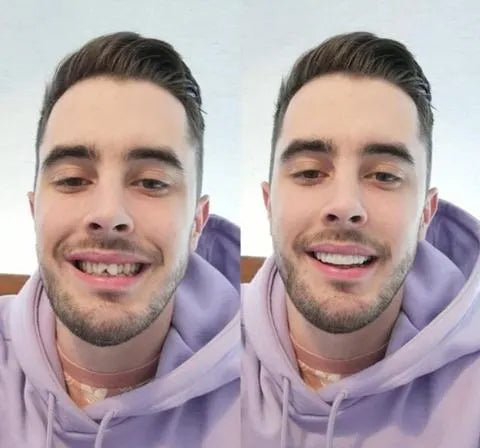 Snap-On-Smile-Veneers (Ober- und Unterkiefer inbegriffen)