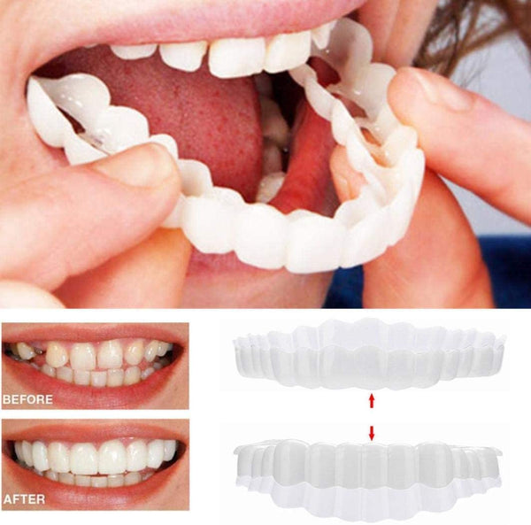 Snap-On-Smile-Veneers (Ober- und Unterkiefer inbegriffen)